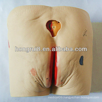 ISO Advanced Bedsores/Pressure Sore Simulator, Decubitus Ulcer Nursing Care Model